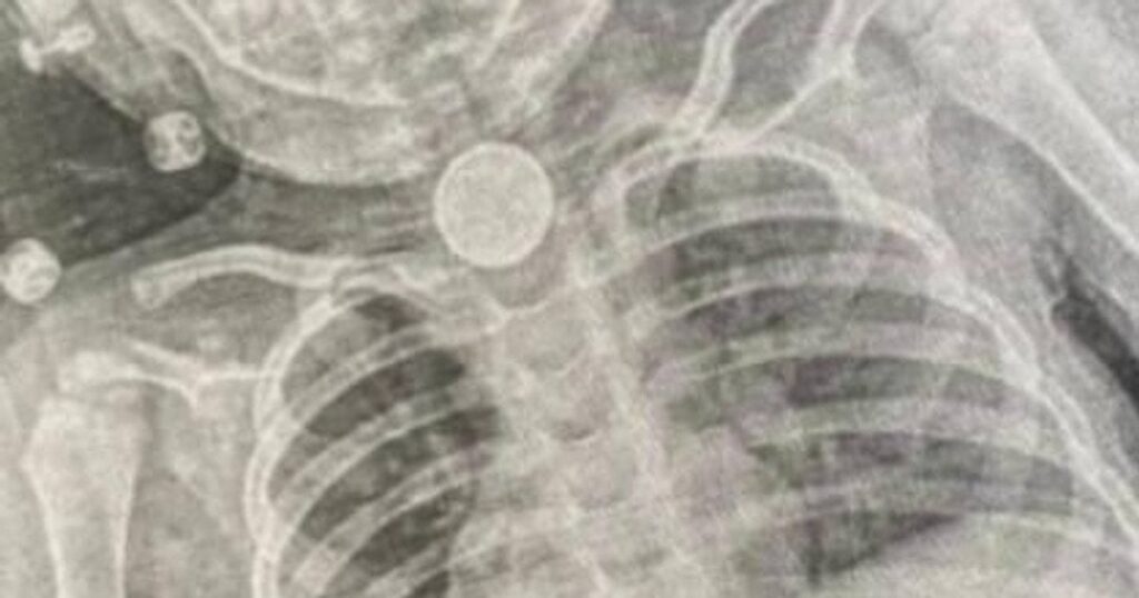 Порятунок 2-річної дівчинки у Львові - всю зиму в стравоході була батарейка — Укрaїнa