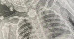 Порятунок 2-річної дівчинки у Львові - всю зиму в стравоході була батарейка — Укрaїнa