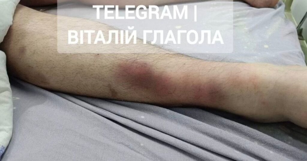 Киянин був у критичному стані після тримання у Воловецькому ТЦК — журналіст довідався деталі жахливої смерті Киянин був у критичному стані після тримання у Воловецькому ТЦК — журналіст довідався деталі жахливої смерті