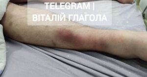 Жахлива трагедія на Закарпатті: Киянин помер у критичному стані після перебування у Воловецькому ТЦК – деталі шокуючої історії
