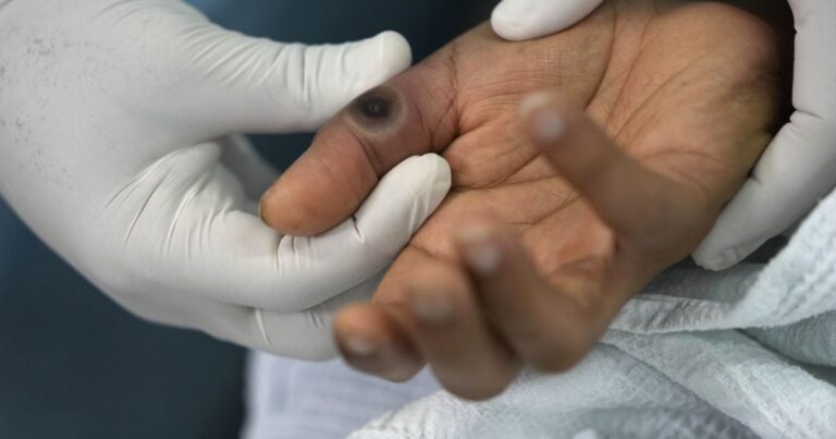 Мавпяча віспа в Підмосков’ї: спалах смертельної інфекції та ізоляція контактних осіб